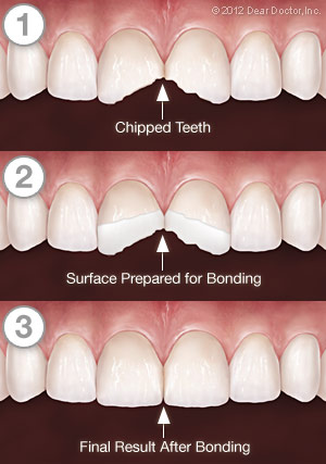 Bonding step by step image
