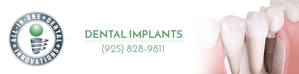Dental Implants in Dublin, CA