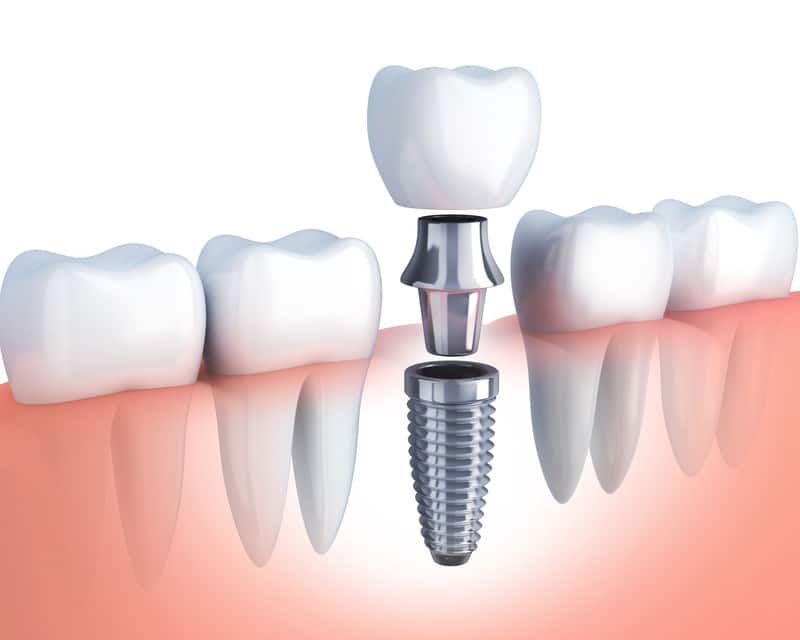 Are Dental Implants Permanent
