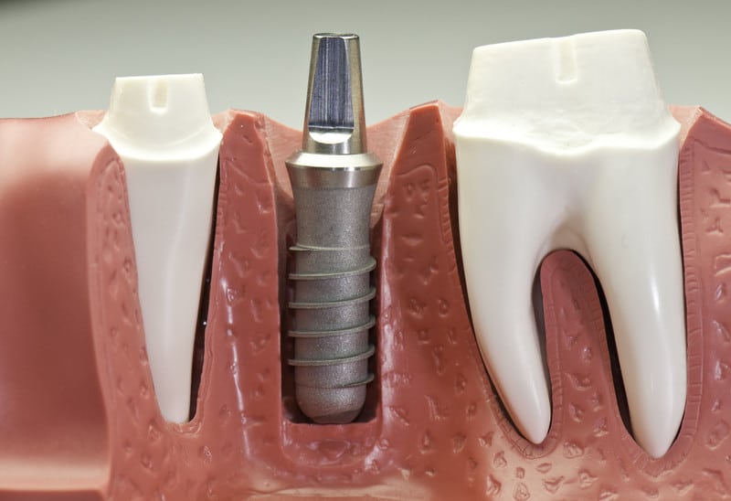 Dental Implant Step By Step Guide