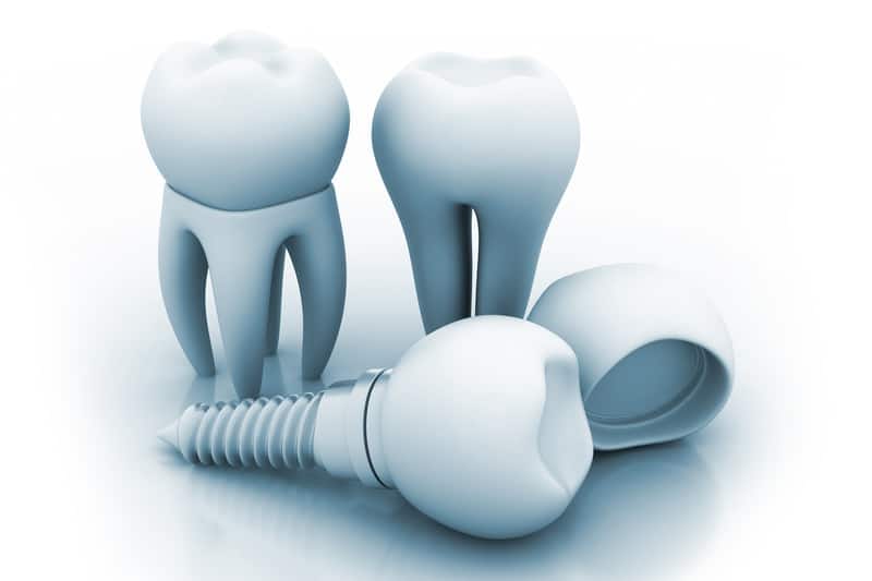 How Exactly Do Dental Implants Work?