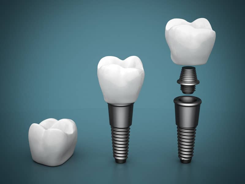 How Safe Is A Dental Implant?