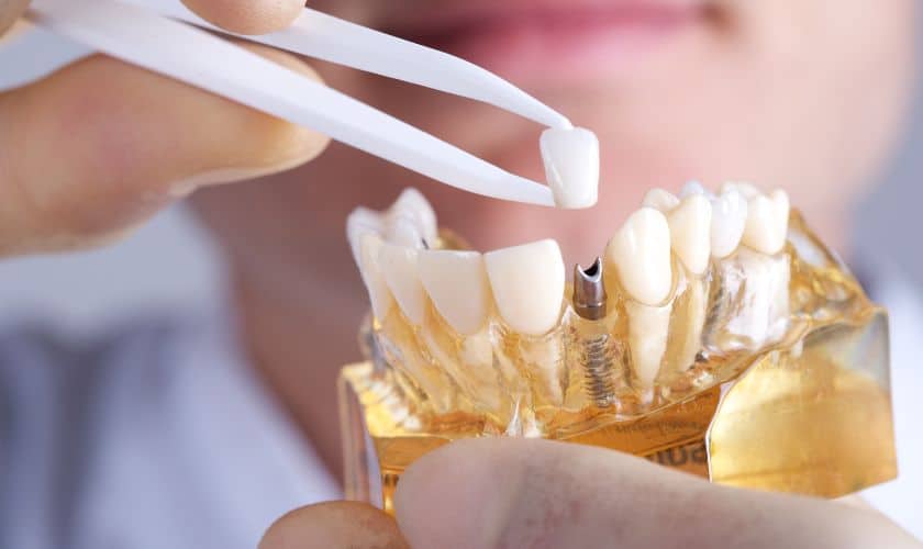 Dental Implant in Dublin