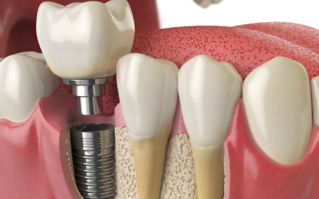 Common Side Effects Of Dental Implant Surgery