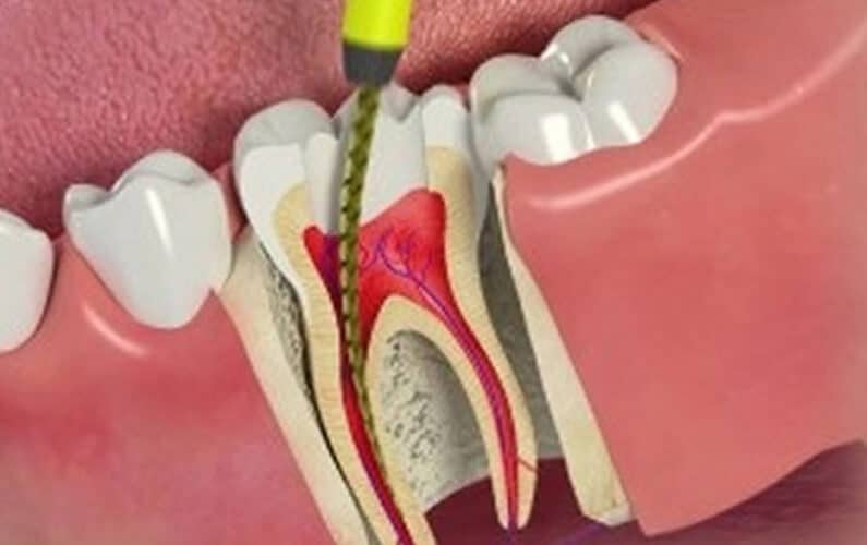 canal root therapy treatment endodontic procedure guide step canals dentistry dental means endodontics patient lesions