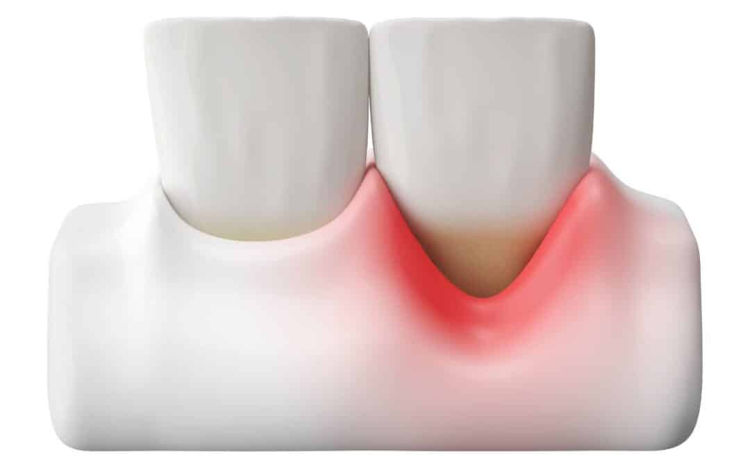 Will Receding Gums Grow Back?