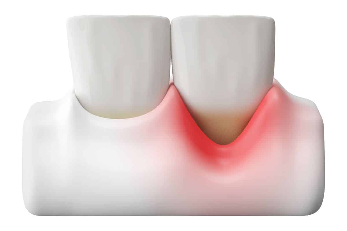 receding gum model
