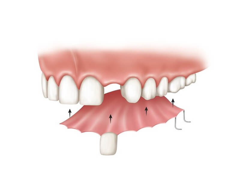 Partial Dentures For Single Tooth Replacement