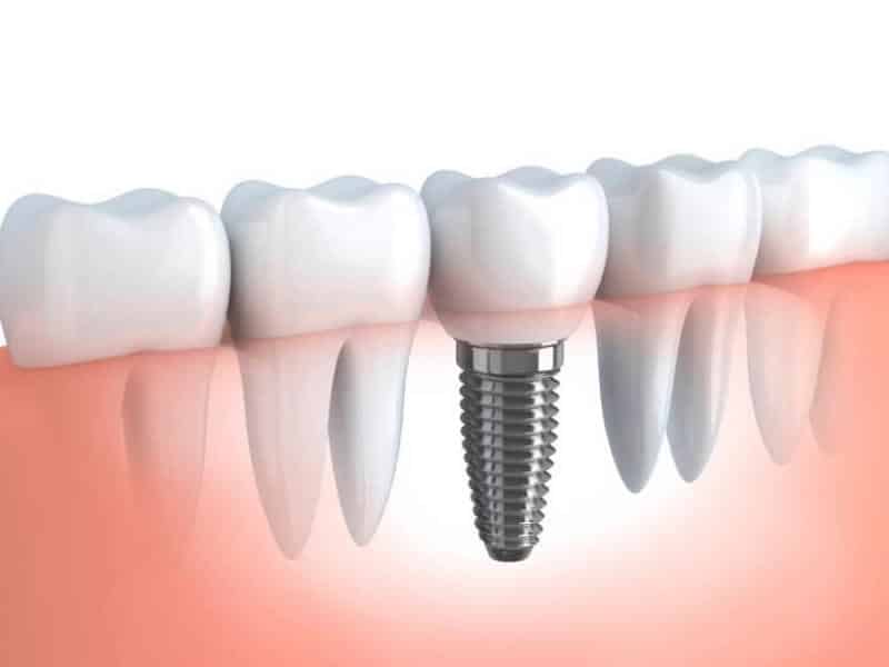 Single Tooth Replacement With Implant