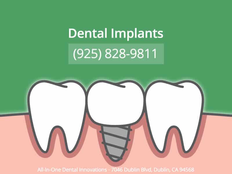 All in One Dental Implants