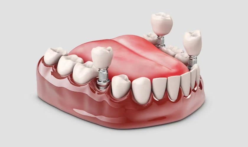 Facts About All On 4 Dental Implants