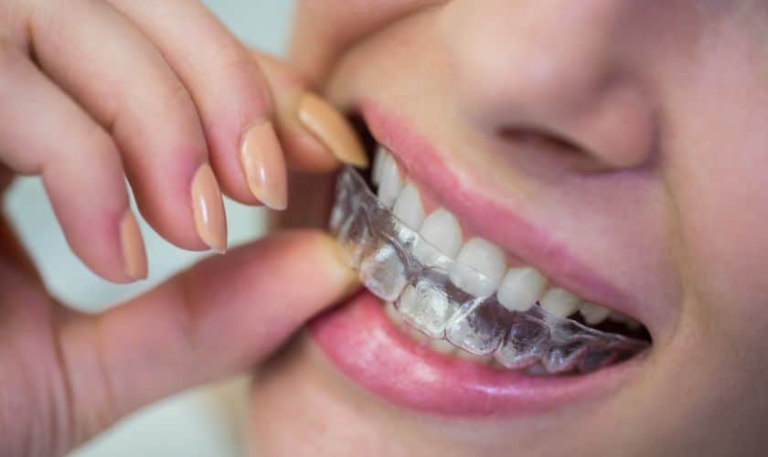 5 Things Adults Should Know When Choosing An Invisalign Orthodontist