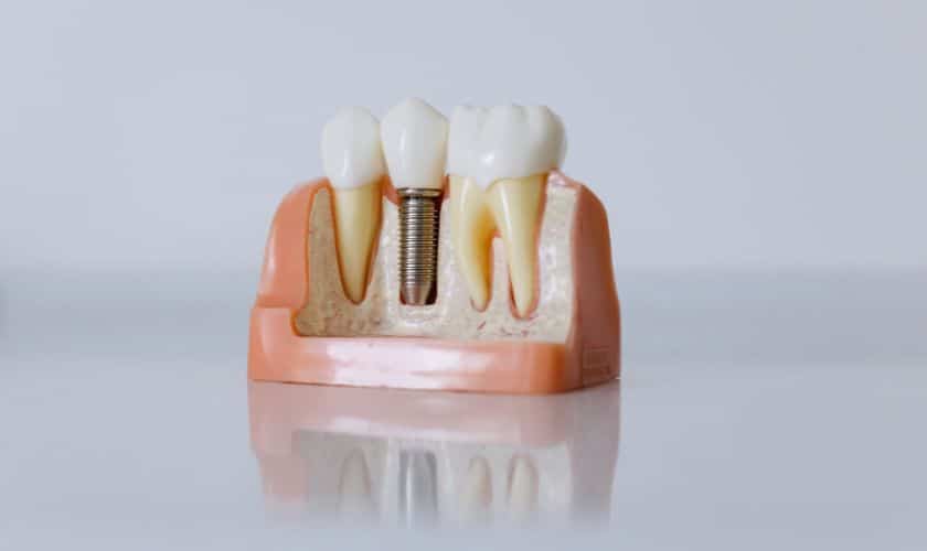 Unlocking the Benefits of Dental Implants: A Permanent Solution with Natural Results
