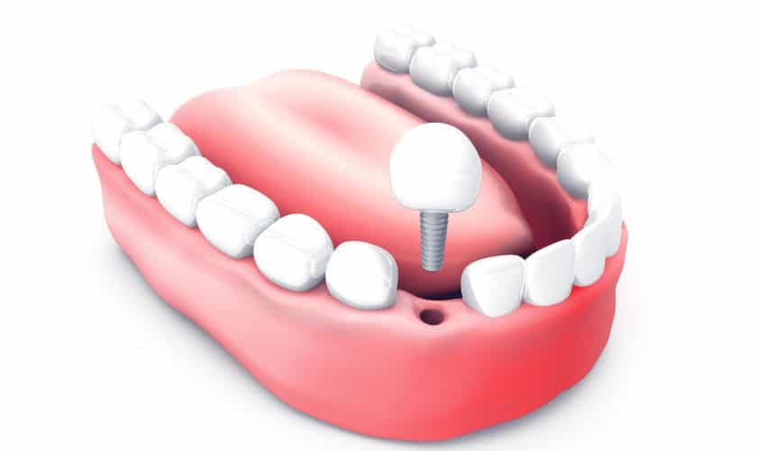How Dental Implants Can Transform Your Smile and Boost Your Confidence in Dublin