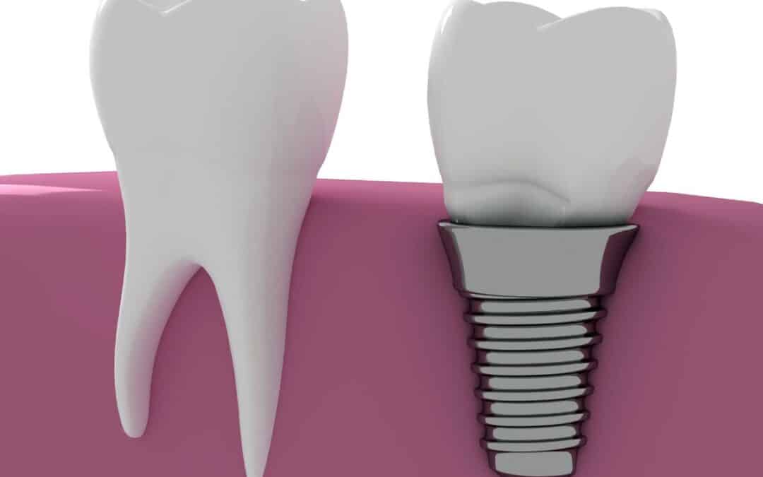 Latest Innovations in Dental Implantology