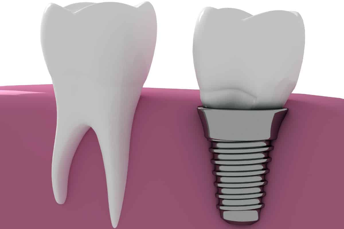 how dental implant looks demo image