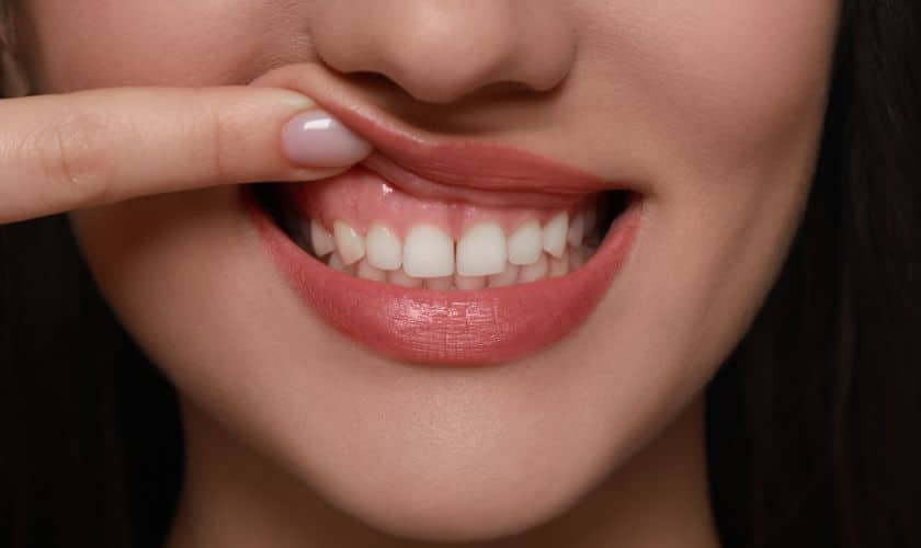 Gummy Smile Treatment