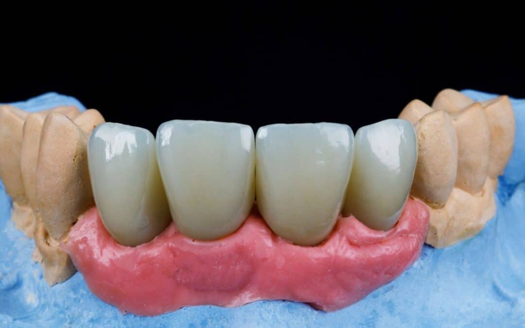 How Long A Dental Bridge Last