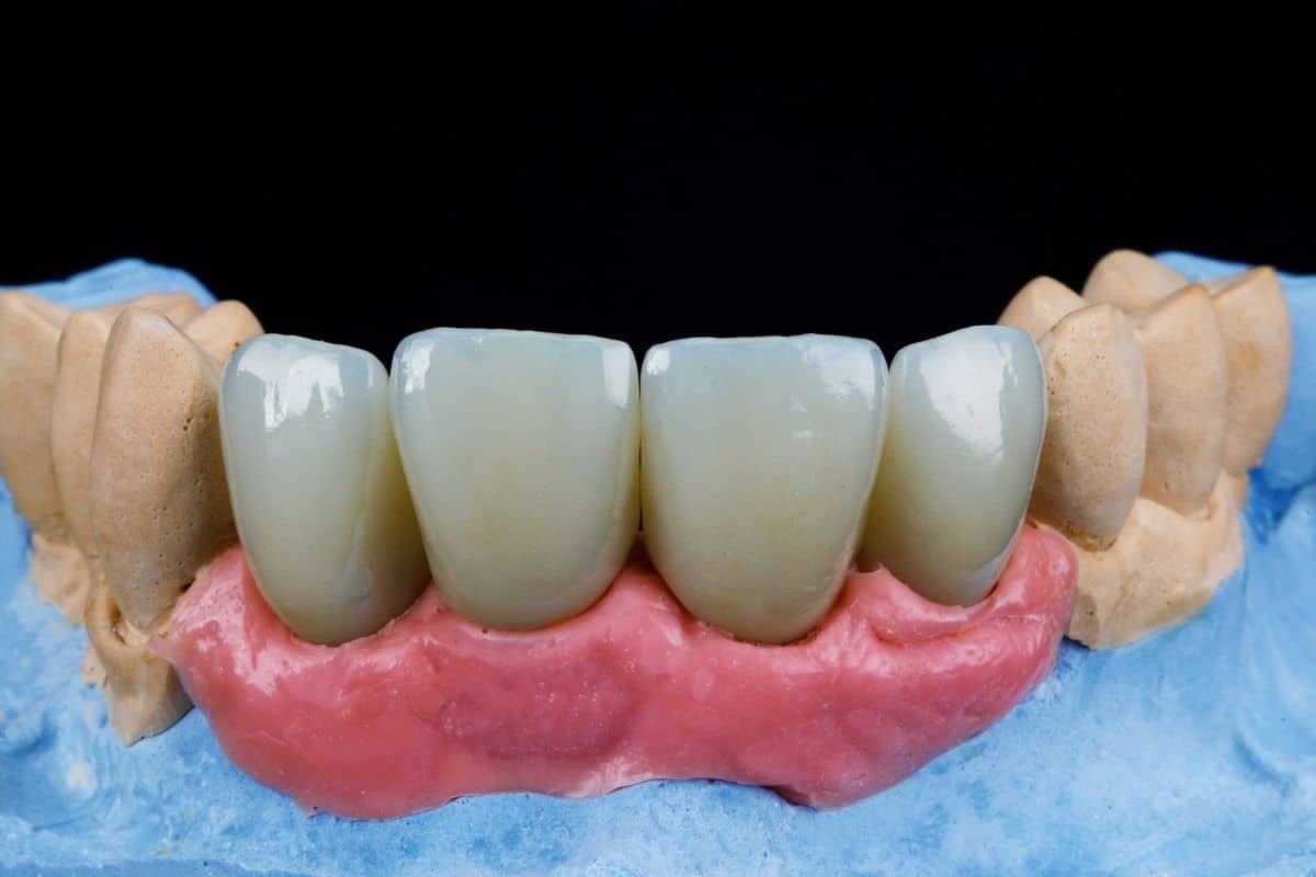dental bridges lifespan