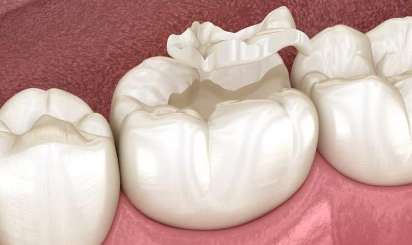 dental sealants