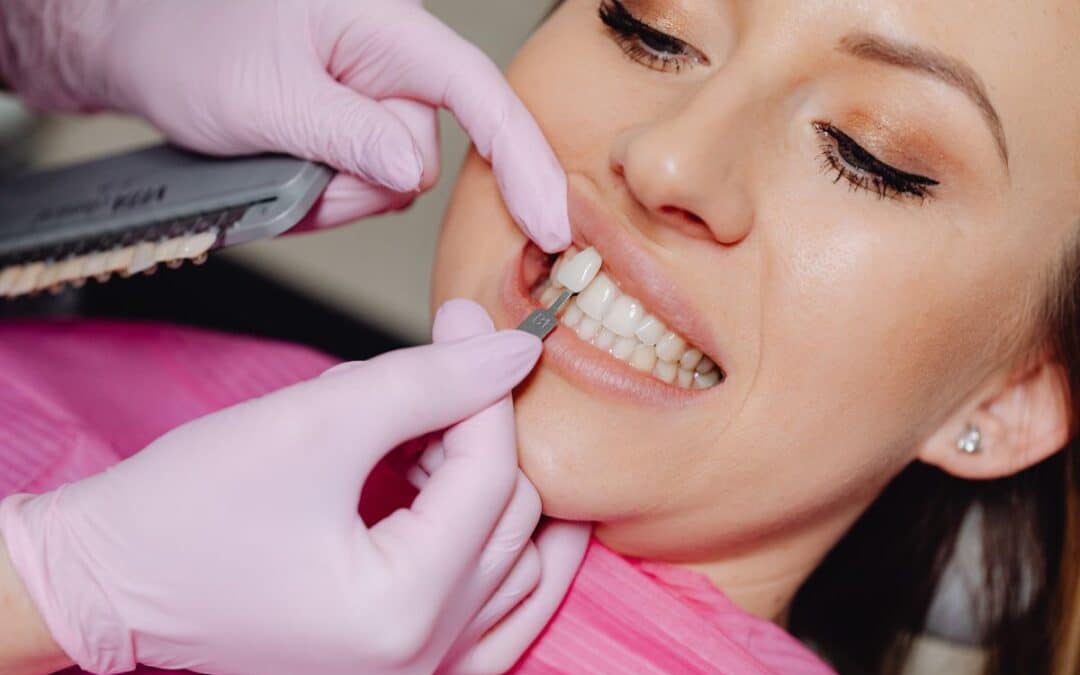 Dental Bonding for Fluorosis