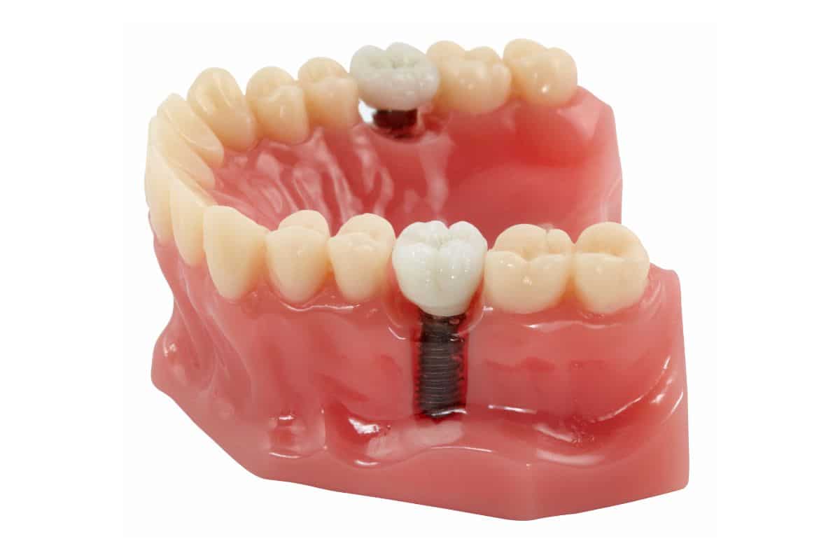 dental implant