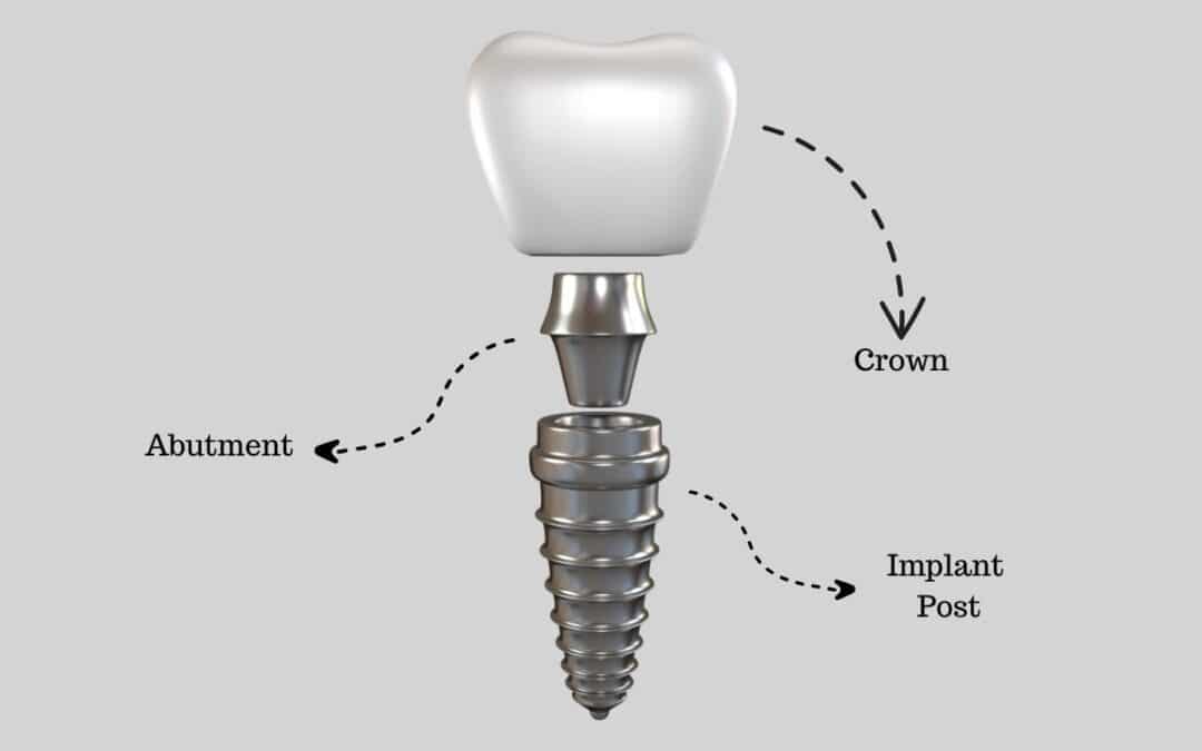 What Are Dental Implants Made Of – Everything You Need to Know