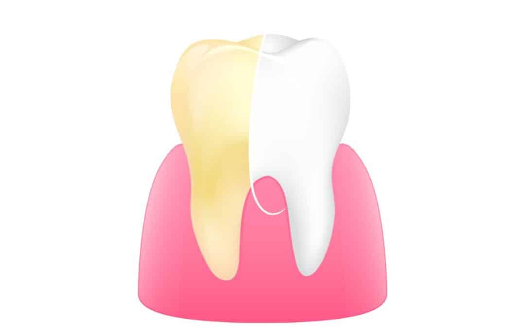 How to Remove Teeth Stains and Whiten Your Smile: Causes, Treatments