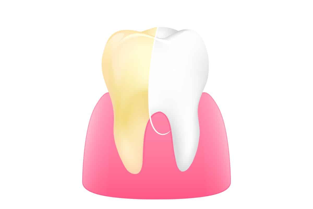 stained teeth and whitening demonstration
