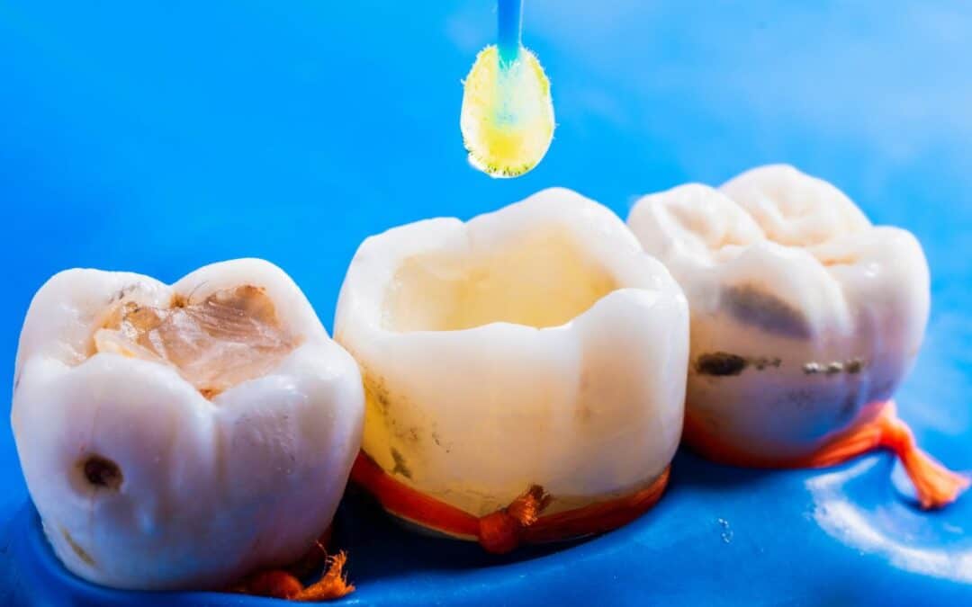 Can You Brush Your Teeth After a Cavity Filling?