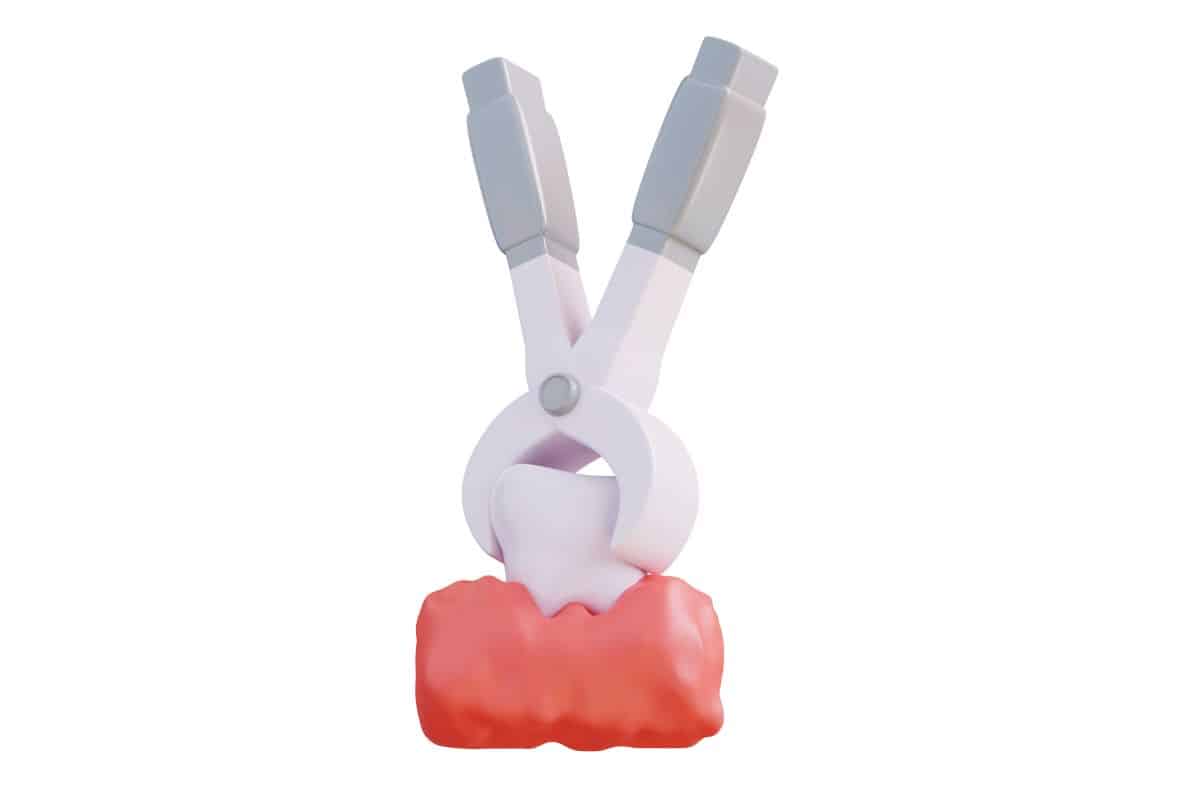wisdom tooth extraction