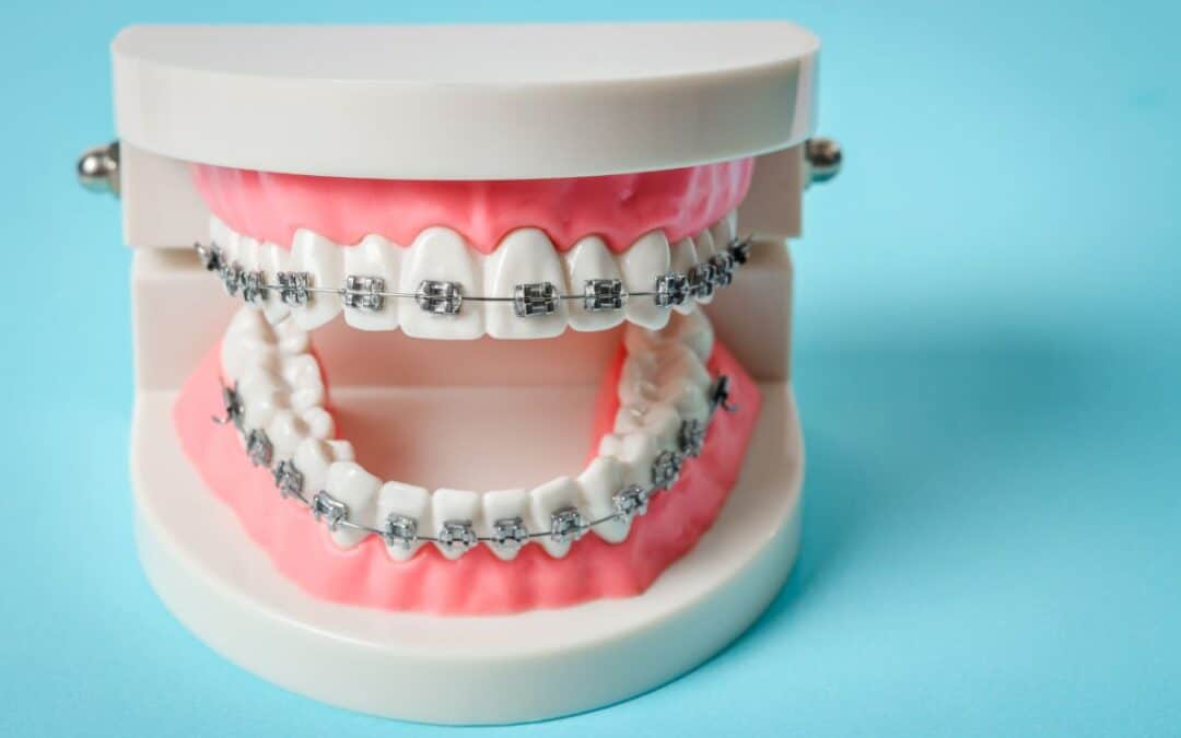 Teeth Whitening After Braces