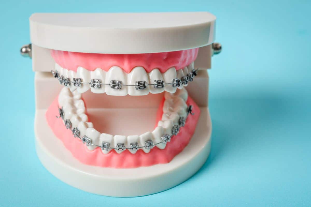 braces on model teeth structure