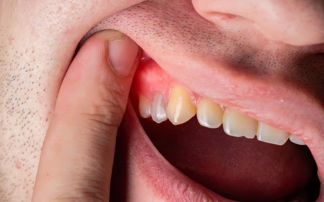 Teeth After Periodontal Disease