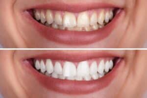 teeth whitening before after