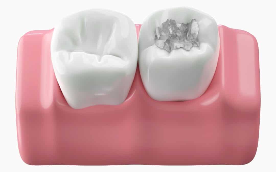 What To Do If Dental Filling Fall Out?
