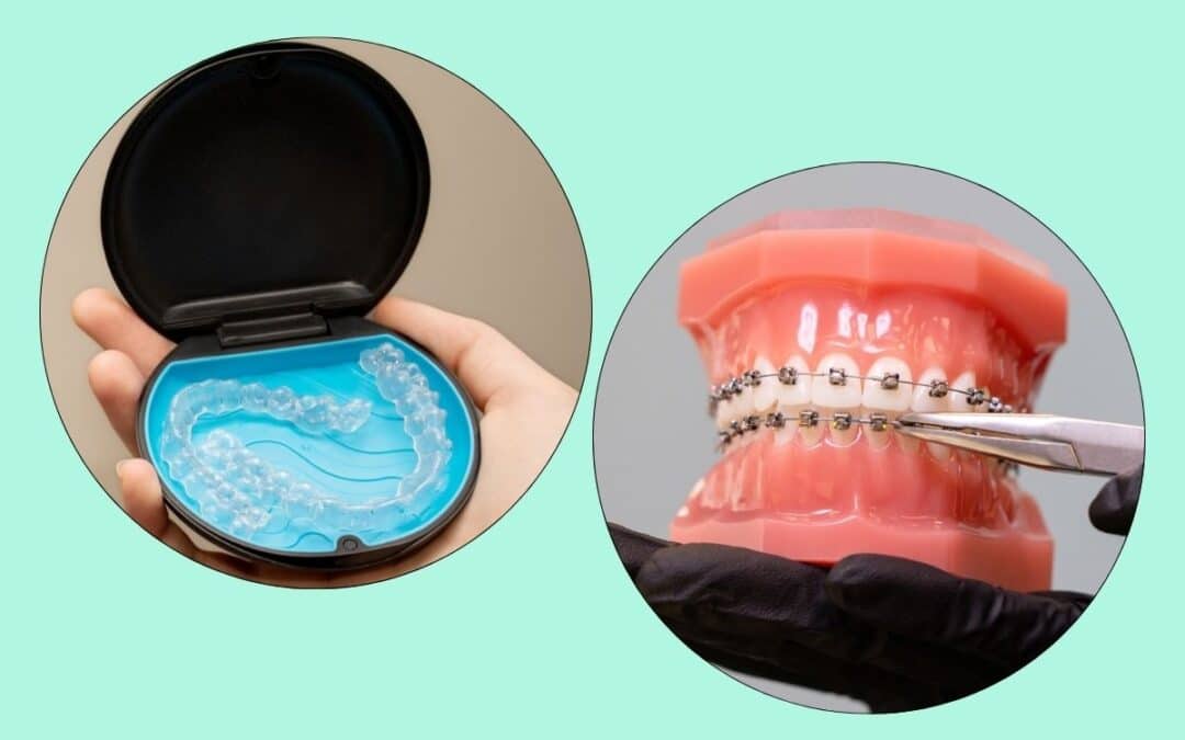Is Invisalign Faster Than Braces?