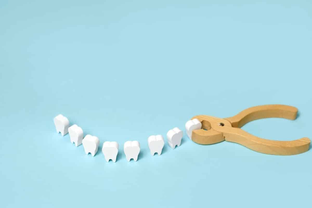 Wisdom tooth extraction