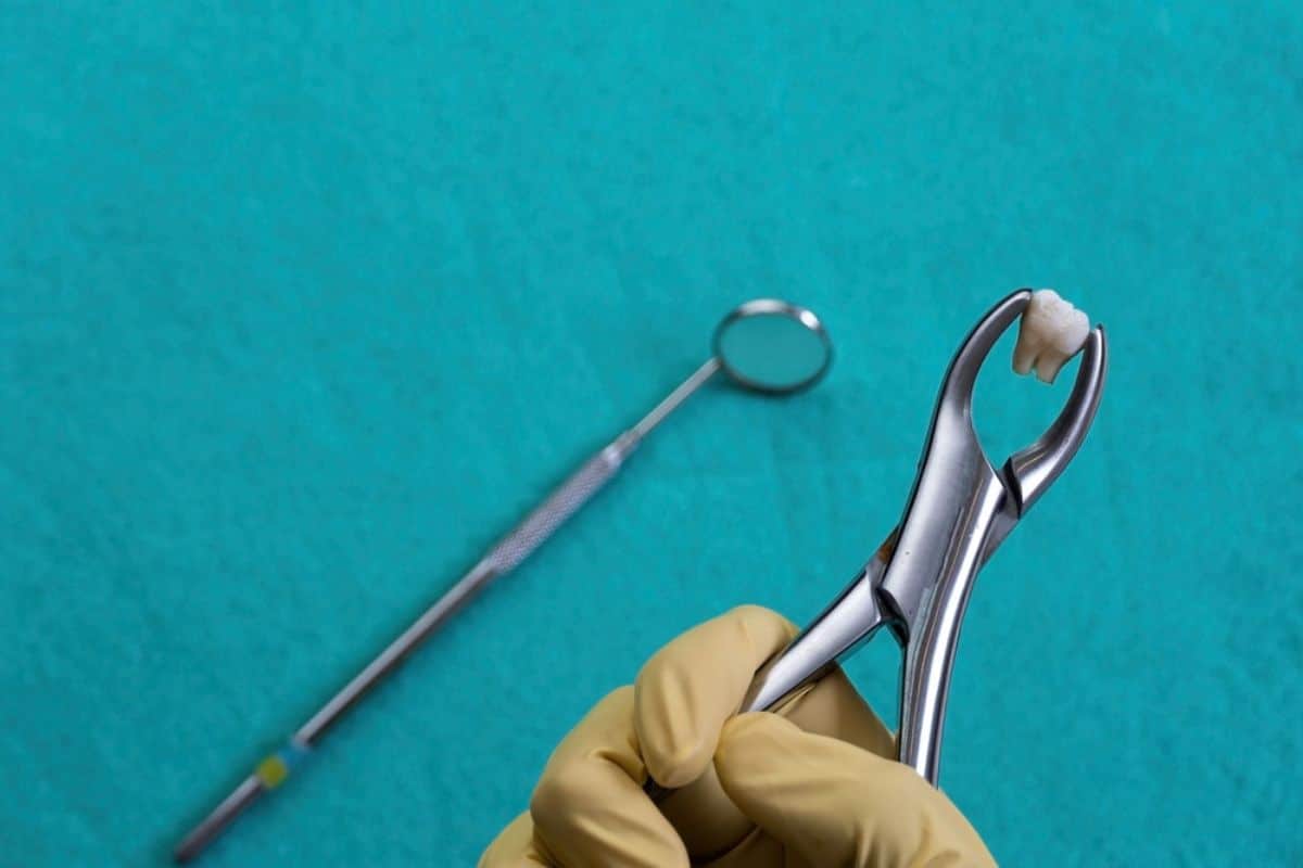 Best Ways to Heal After a Tooth Extraction Faster