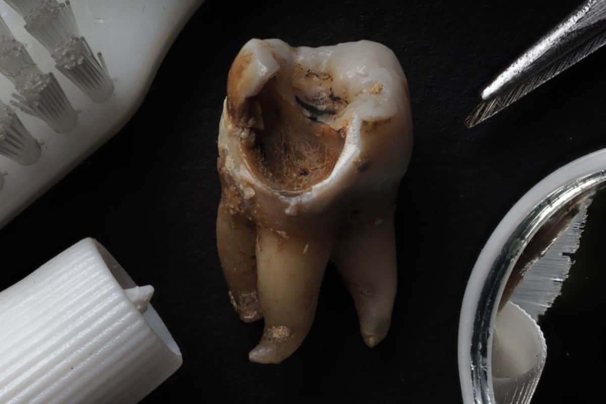 tooth cavity that can not be treated at home