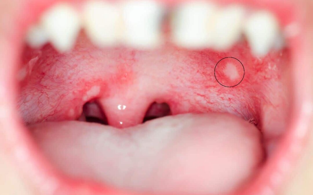 Why Does the Roof of My Mouth Hurt When I Eat?