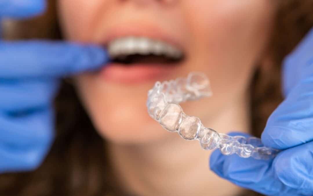 How Long Does Invisalign Take to Work?