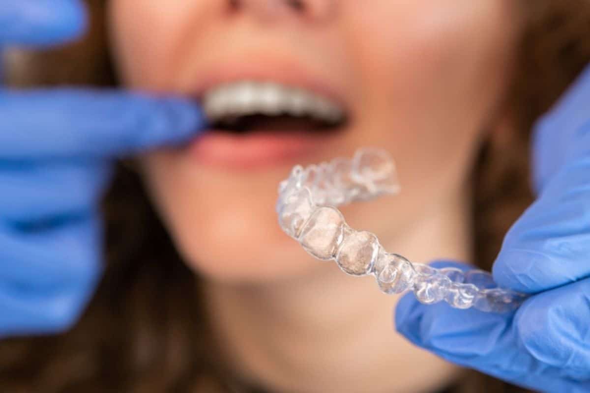 Invisalign time duration