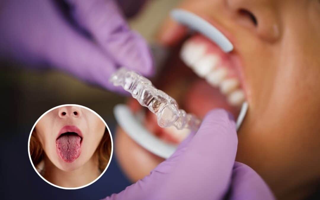 Dry Mouth From Invisalign – Causes And Treatment