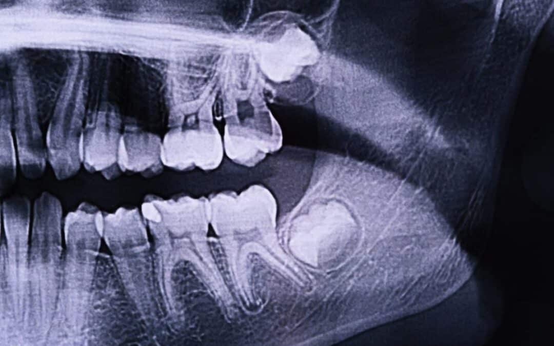 Guide To Early Signs of Wisdom Tooth Infection and What Treatment You Can Get