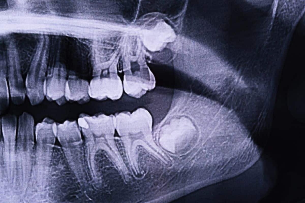 early signs of wisdom tooth infection