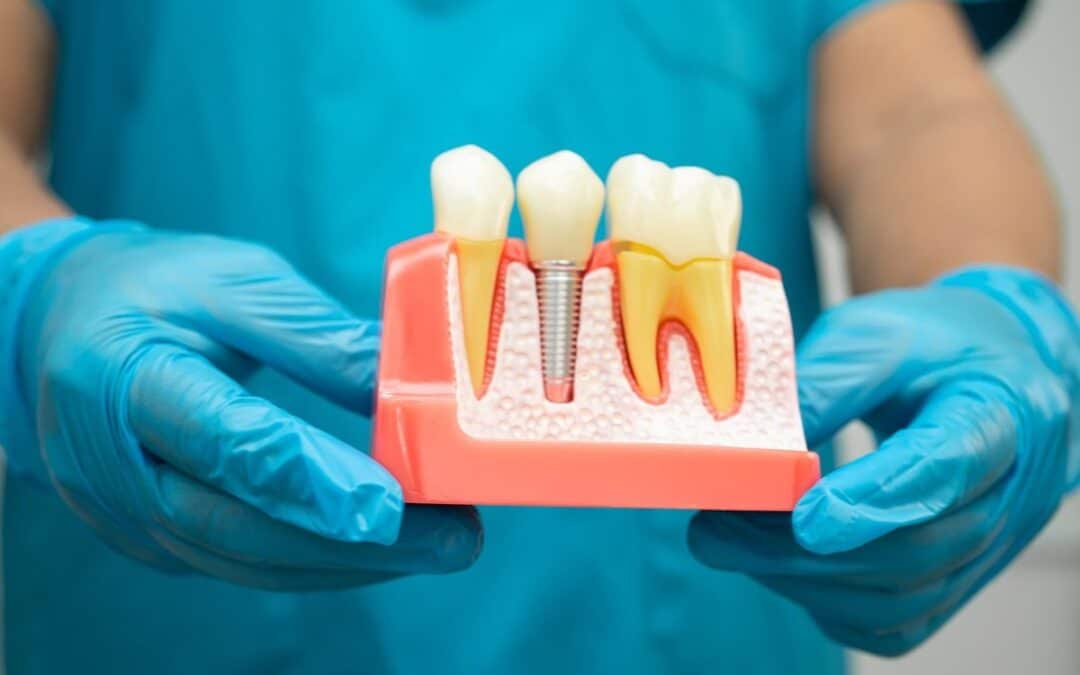 Top Reasons Dental Implants Fail and How To Prevent It