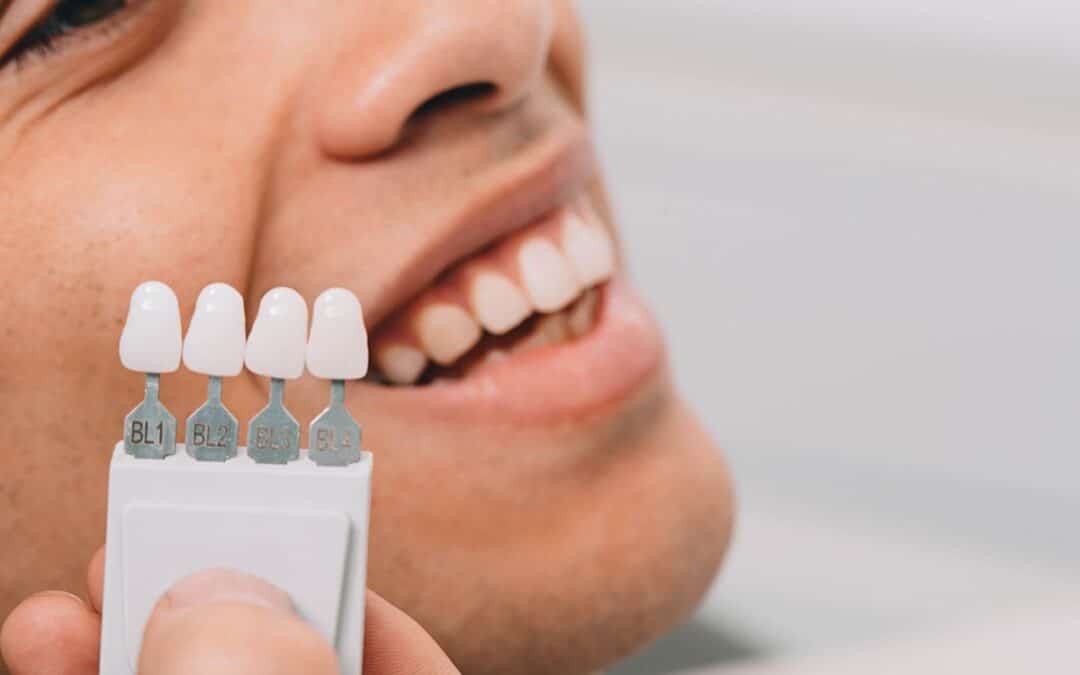 What Are the Risks and Benefits of Dental Veneers?