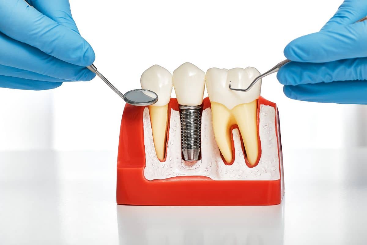 Dental Implants in Dublin