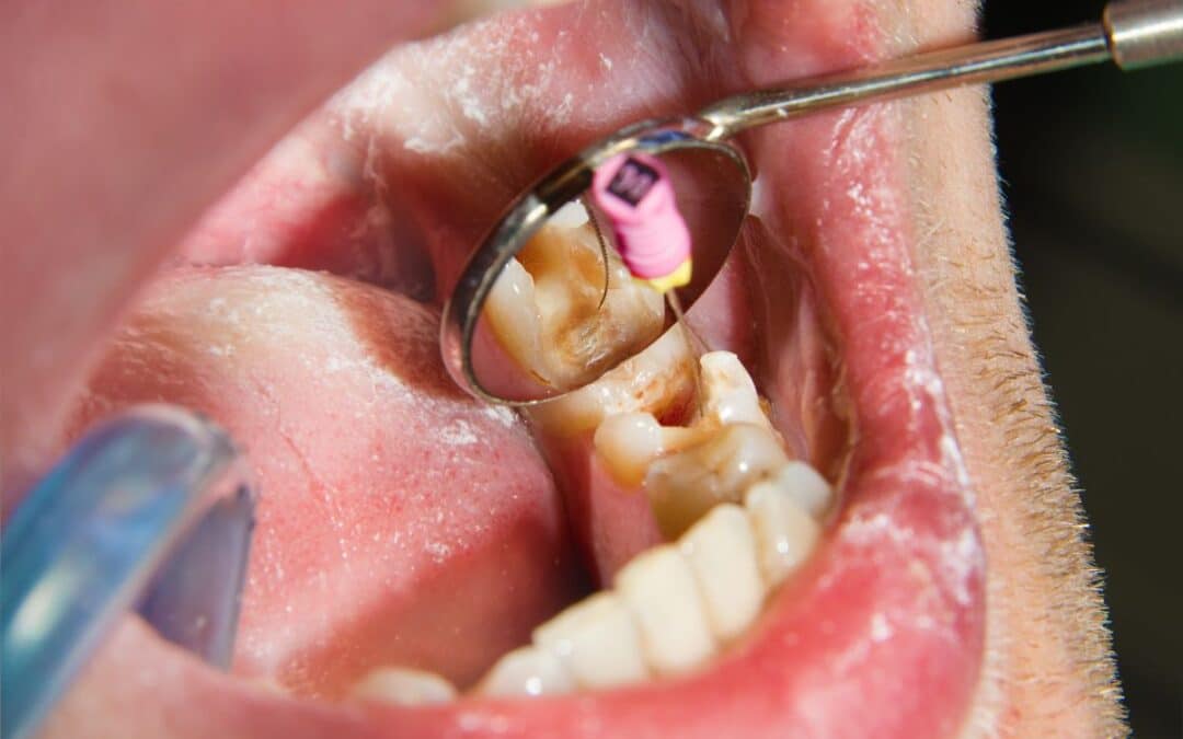How Long Can You Expect Your Dental Fillings To Last?